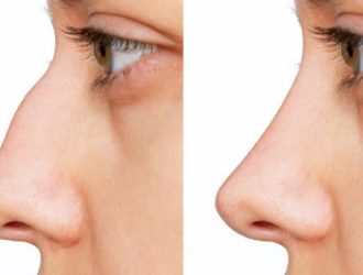 Rhinoplasty in Riyadh