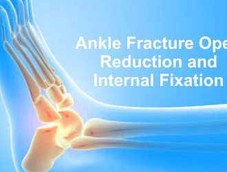 Ankle fracture