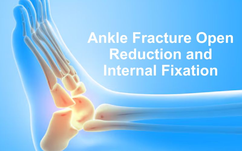 Ankle fracture