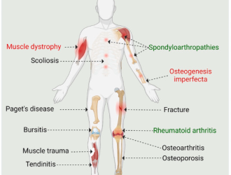 Musculoskeletal Disorders in human