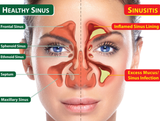 Sinusitis2