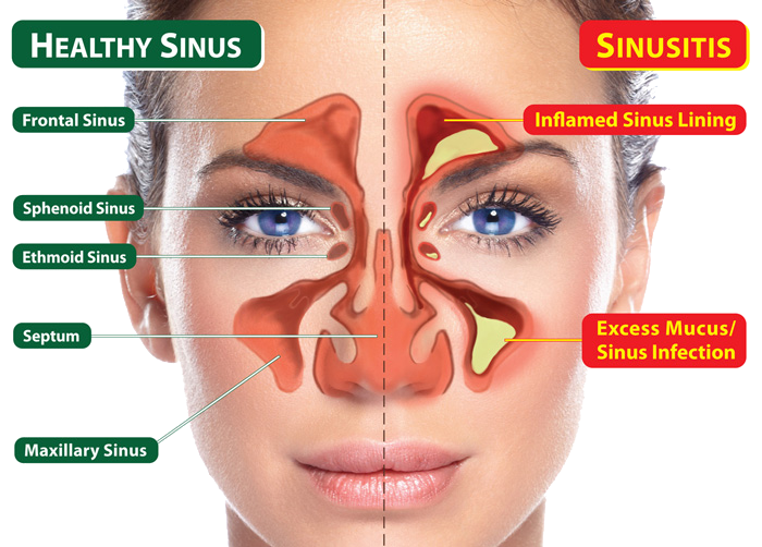 Sinusitis2