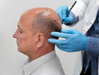 mature-man-going-through-follicular-unit-extraction-process_23-2149106306