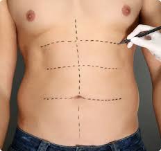 best liposuction in Lahore