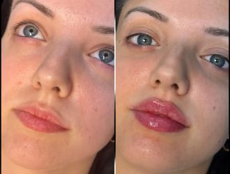 H5-lip-fillers