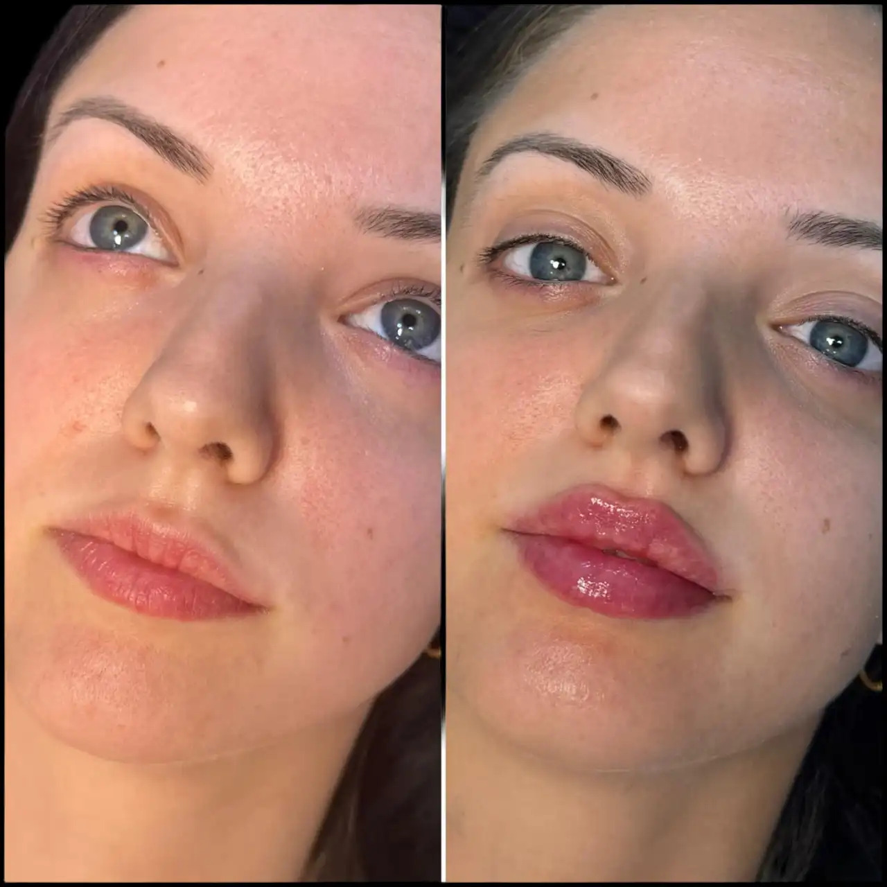 H5-lip-fillers