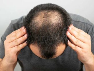 Hair transplant