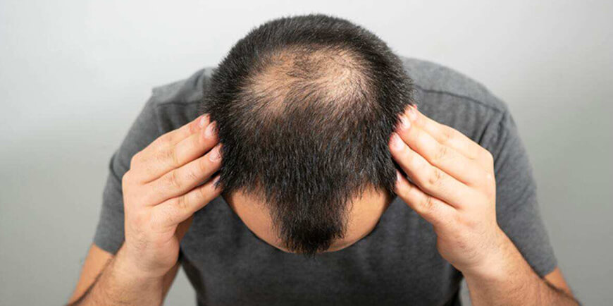 Hair transplant