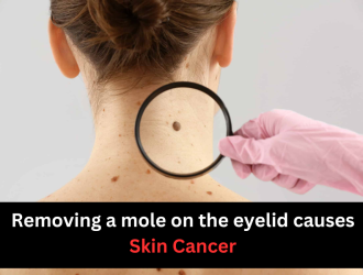 Removing a mole on the eyelid causes Skin Cancer