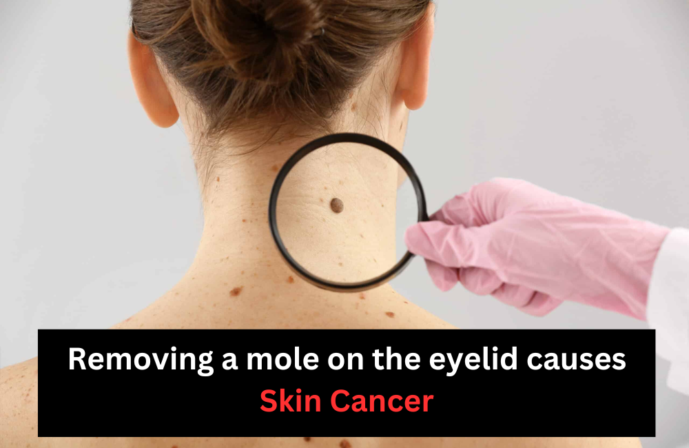 Removing a mole on the eyelid causes Skin Cancer