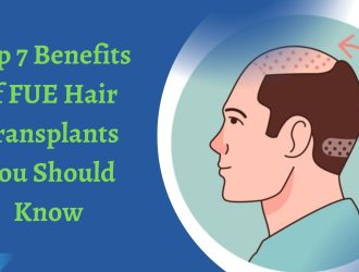 Top 7 Benefits of FUE Hair Transplants You Should Know