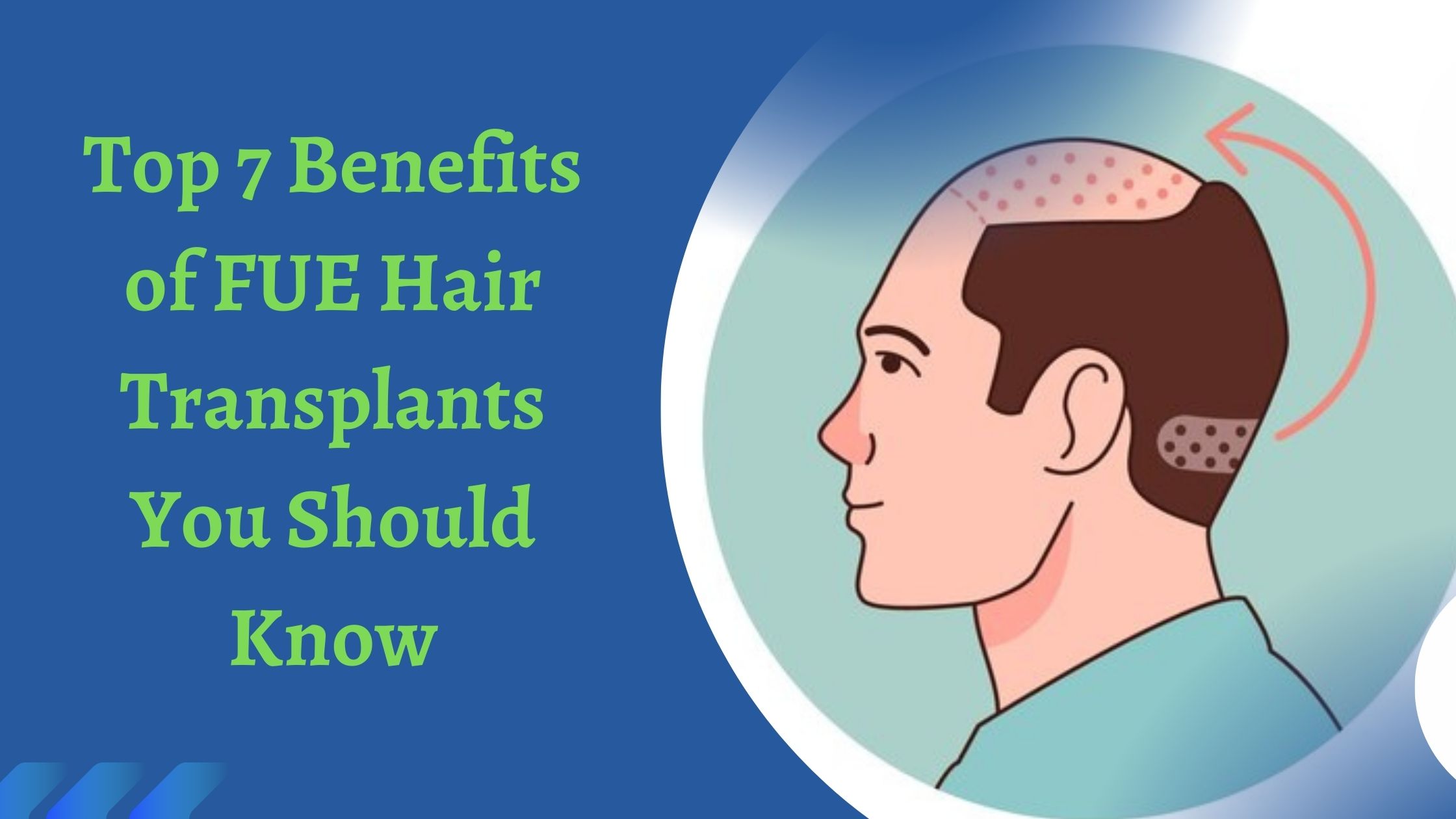 Top 7 Benefits of FUE Hair Transplants You Should Know