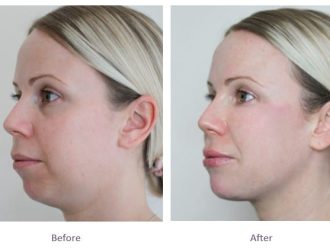 dermal-fillers-full-face-rejuvenation-before-after (1)