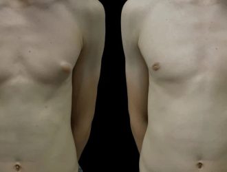 gynecomastiaperfectdoctorsclinic-ezgif.com-webp-to-jpg-converter