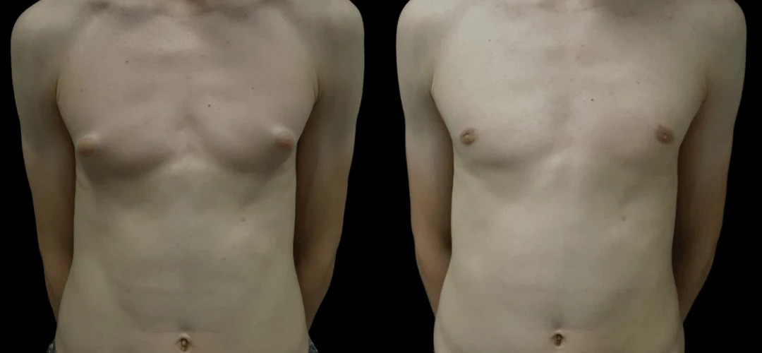 gynecomastiaperfectdoctorsclinic-ezgif.com-webp-to-jpg-converter