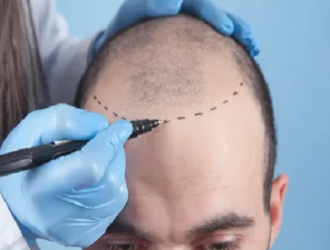 hair-transplant