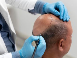 man-going-through-follicular-unit-extraction-process_23-2149106296