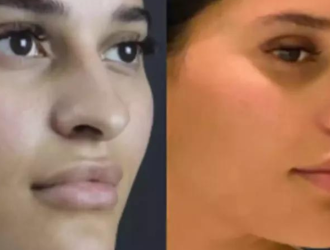 Rhinoplasty in Dubai