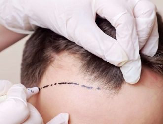 Can a Hair Transplant Fix Balding in the Crown Area