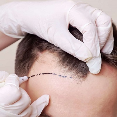 Can a Hair Transplant Fix Balding in the Crown Area