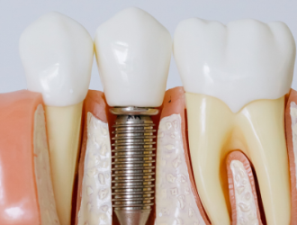 Zirconia Dental Implans