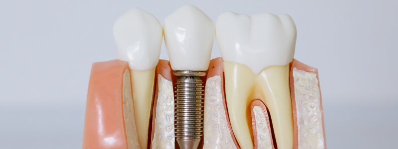 Zirconia Dental Implans